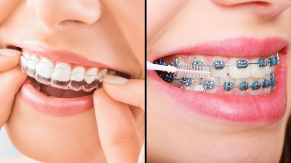 Braces vs. Clear Aligners: Which Is Right for You?